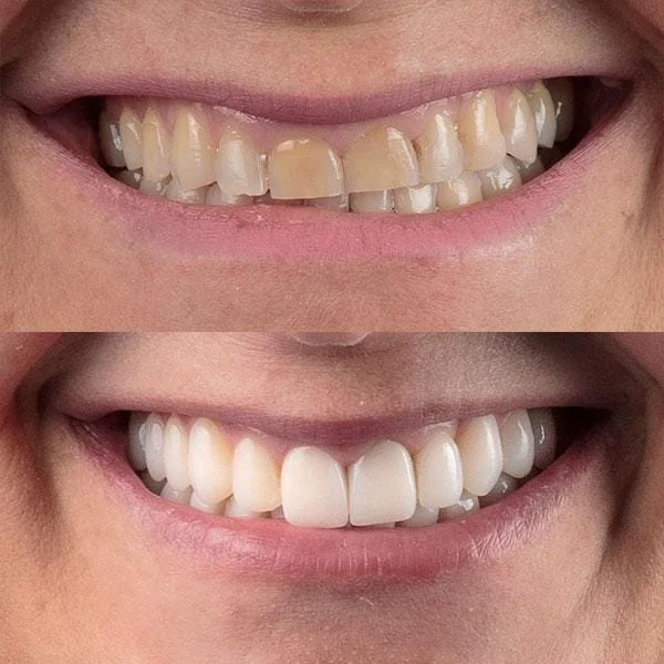 Branqueamento dentário — antes e depois