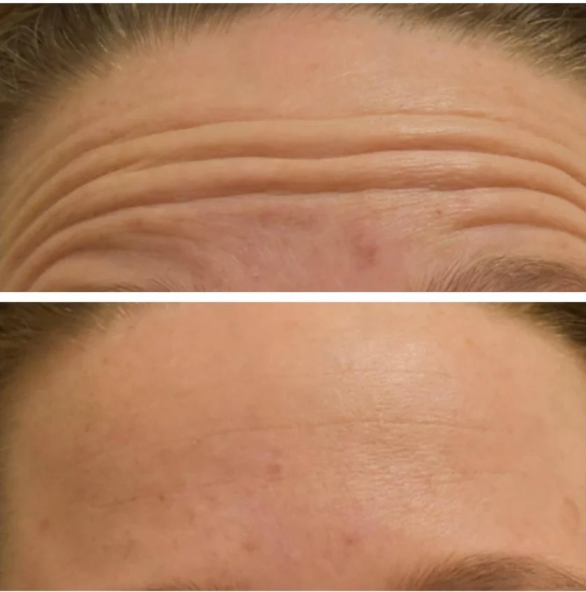 Antes e depois — Harmonização facial testa